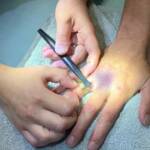 Ring von geschwollenem Finger entfernt